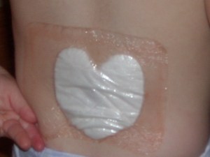 Dreaded spinal surgery just after she began transitioning off her walker.